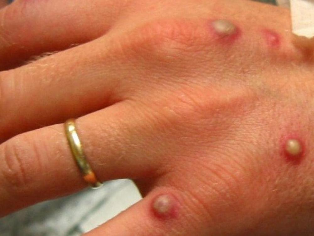 Brasil tem mais de 200 casos confirmados de varíola dos macacos