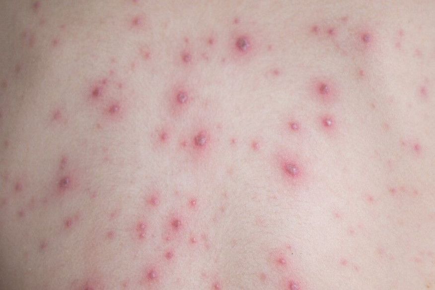 Casos em investigação de varíola dos macacos na Paraíba sobem para 68 nesta quarta-feira